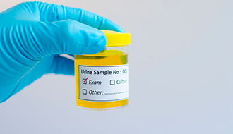 Chlamydia Test