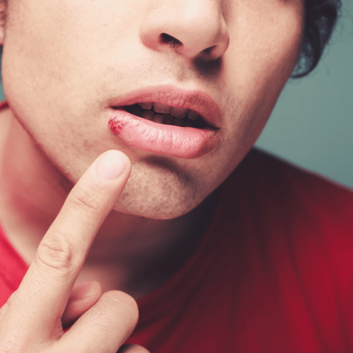 Young Man with Cold Sore (herpes on mouth)