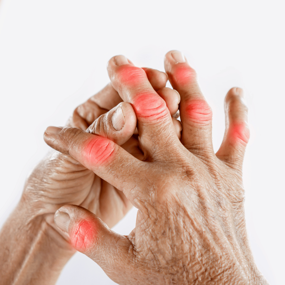 rheumatic hands