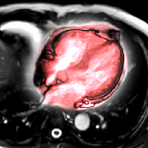 MRI heart or Cardiac MRI