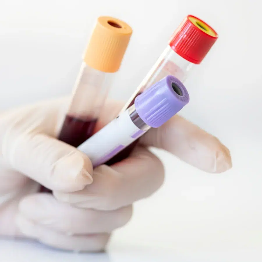 Homocysteine Blood Test tubes