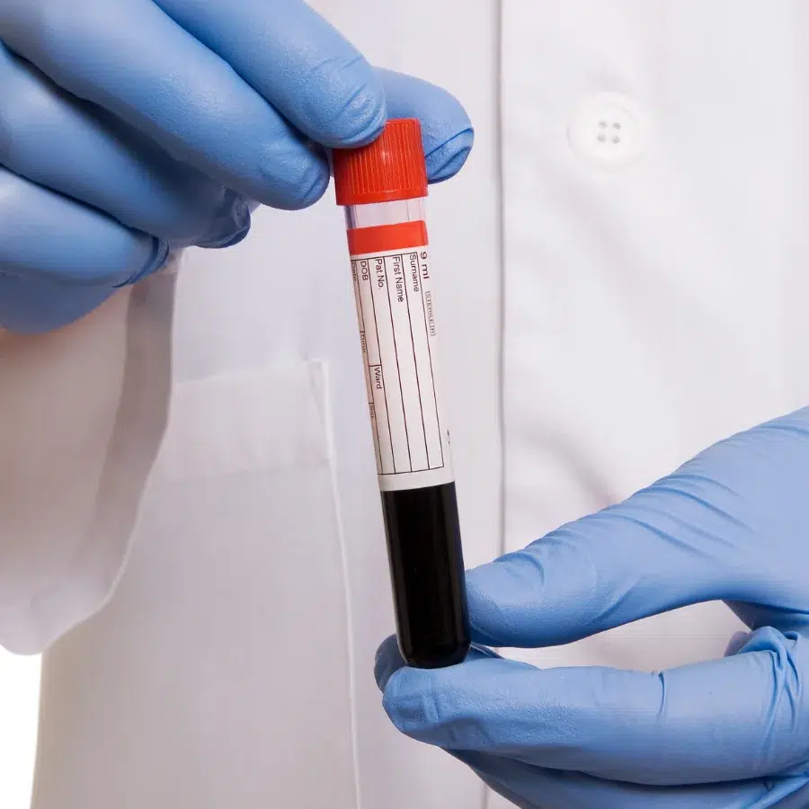 Lipoprotein a test tube image
