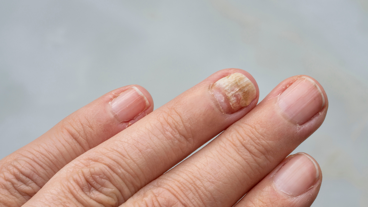 Close-up of finger with fungal nail infection